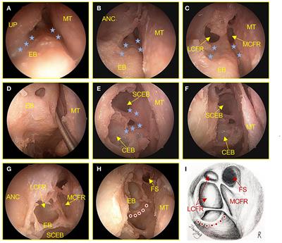 Precision Endonasal Endoscopic Surgery of the Frontal Recess Cells and Frontal Sinus Guided by the Natural Sinus Drainage Pathway